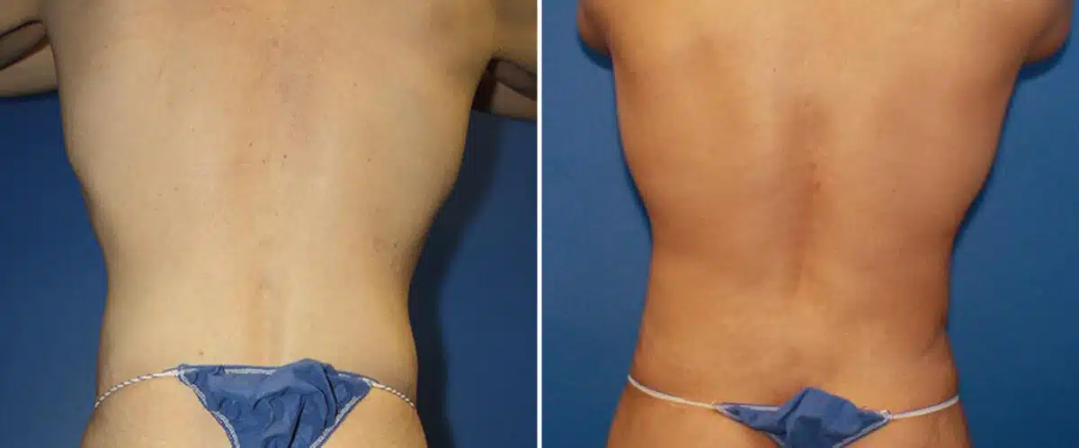 Body Lift Before and After Photos in New York, NY, Patient 15751