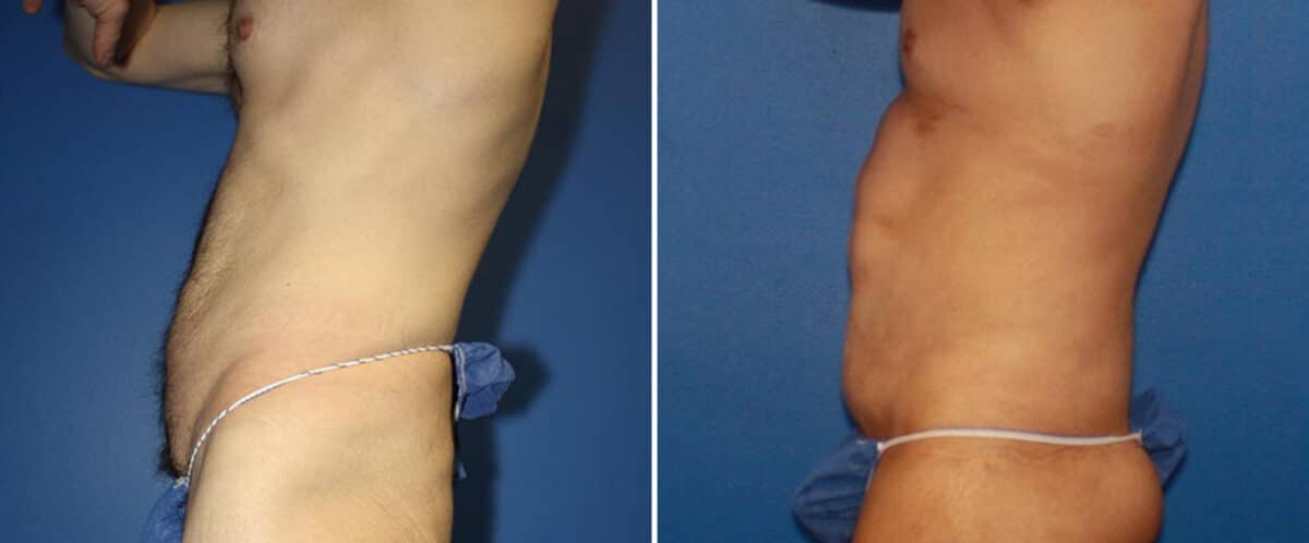 Body Lift Before and After Photos in New York, NY, Patient 15751