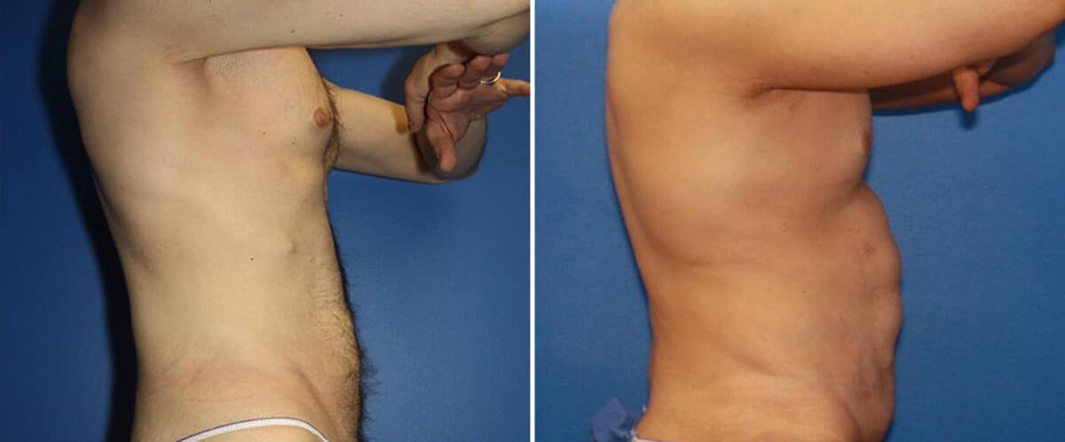 Body Lift Before and After Photos in New York, NY, Patient 15751