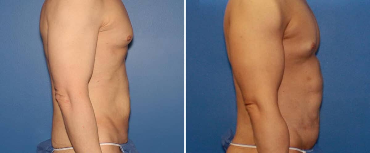 Body Lift Before and After Photos in New York, NY, Patient 15751