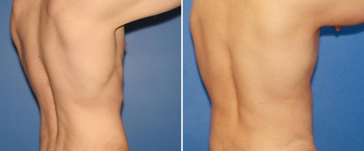 Body Lift Before and After Photos in New York, NY, Patient 15751