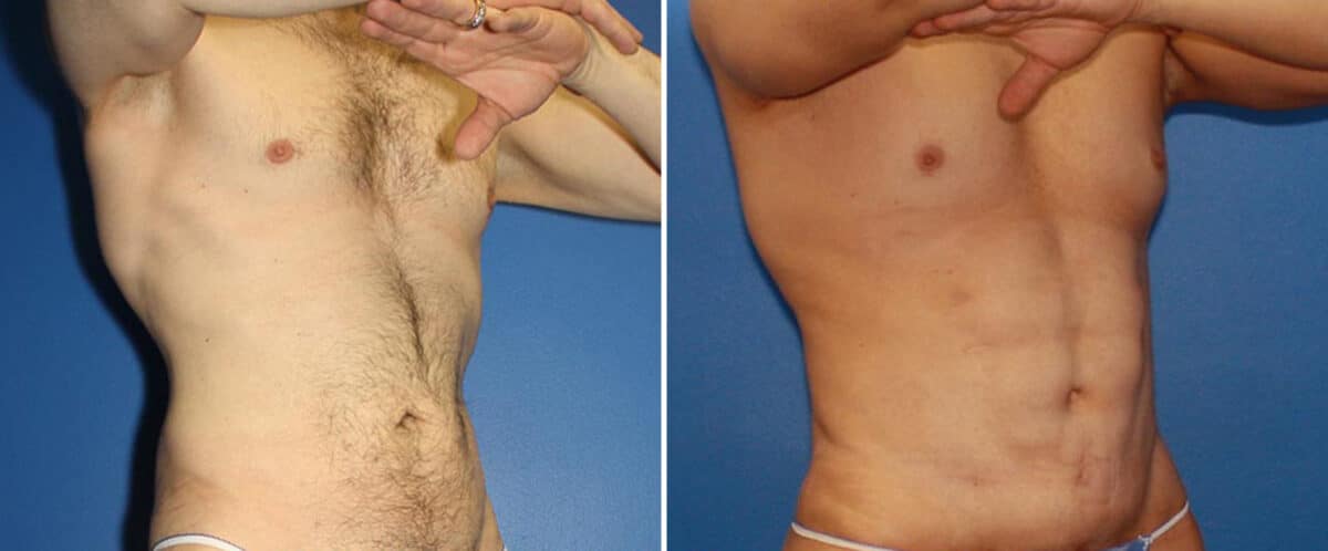 Body Lift Before and After Photos in New York, NY, Patient 15751