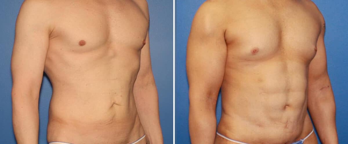 Body Lift Before and After Photos in New York, NY, Patient 15751