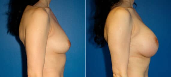 Breast Augmentation Before and After Photos in New York, NY, Patient 15449