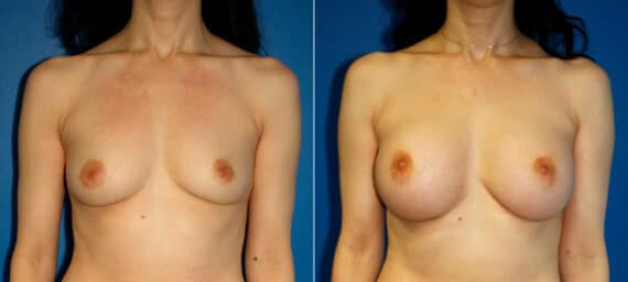 Breast Augmentation Before and After Photos in New York, NY, Patient 15449