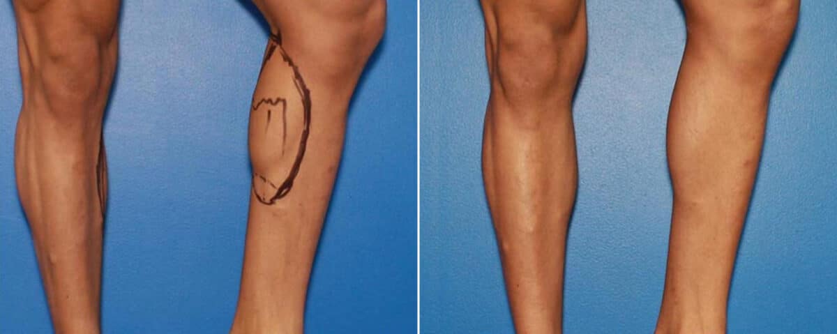 Calf Implants Before and After Photos in New York, NY, Patient 15855