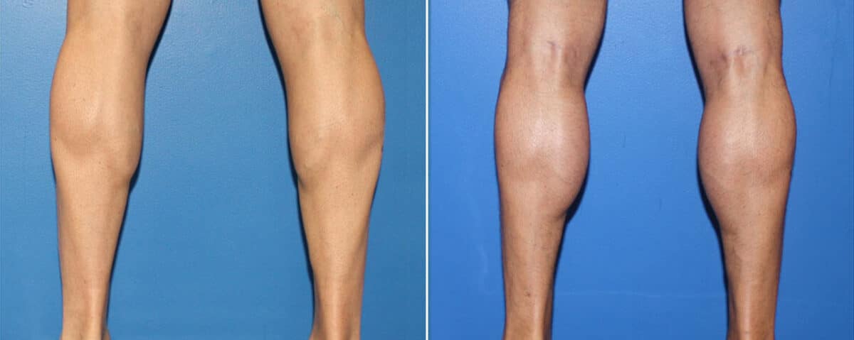 Calf Implants Before and After Photos in New York, NY, Patient 15887