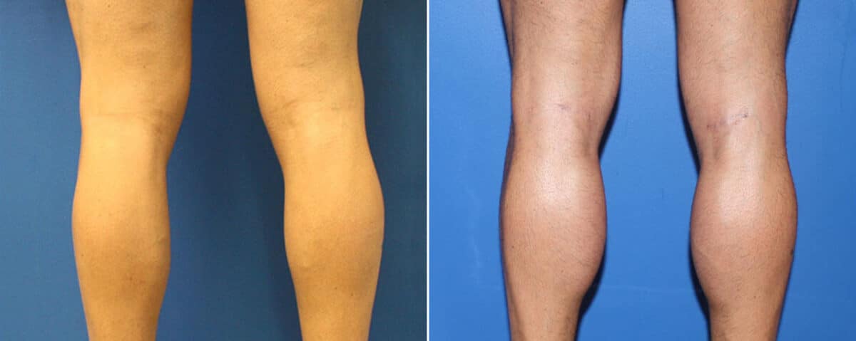 Calf Implants Before and After Photos in New York, NY, Patient 15887