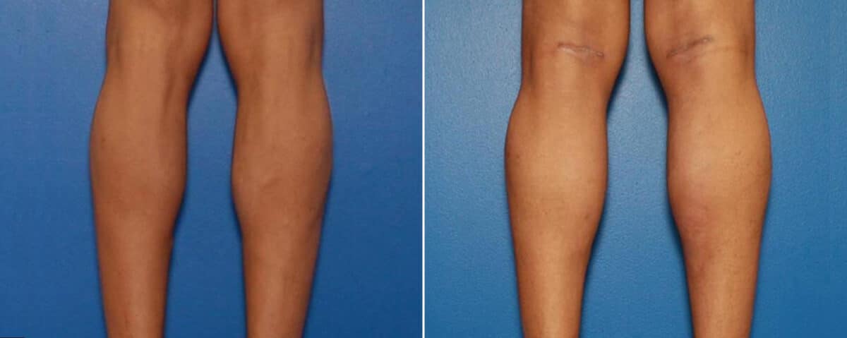 Calf Implants Before and After Photos in New York, NY, Patient 15855