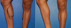 Calf Implants Before and After Photos in New York, NY, Patient 15855