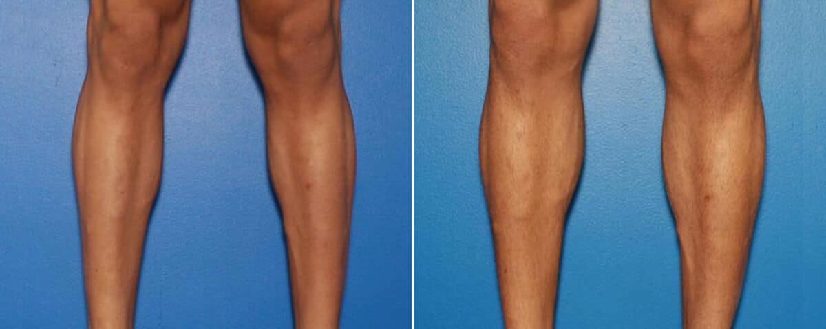 Calf Implants Before and After Photos in New York, NY, Patient 15855