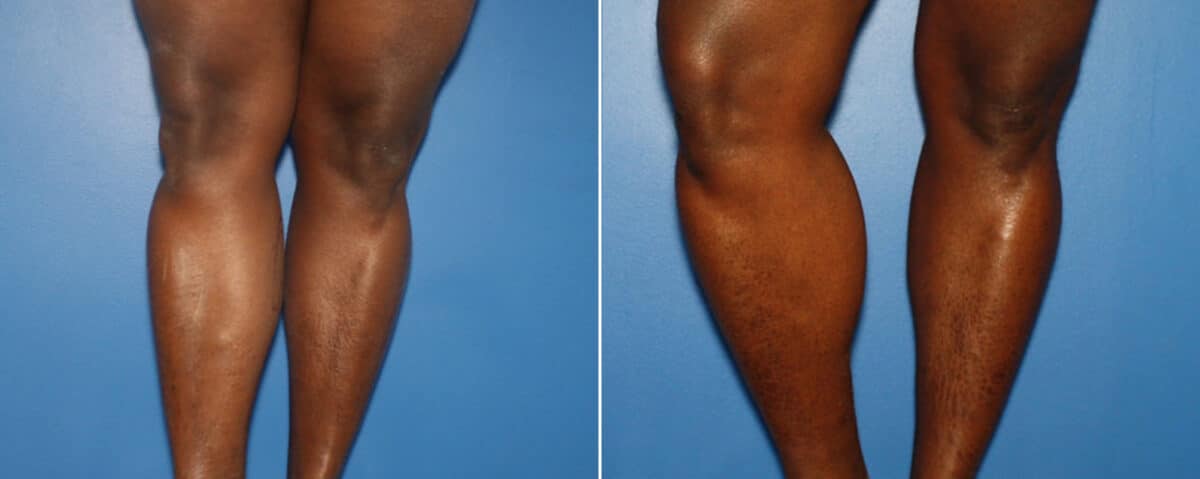 Calf Implants Before and After Photos in New York, NY, Patient 15871