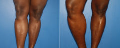 Calf Implants Before and After Photos in New York, NY, Patient 15871