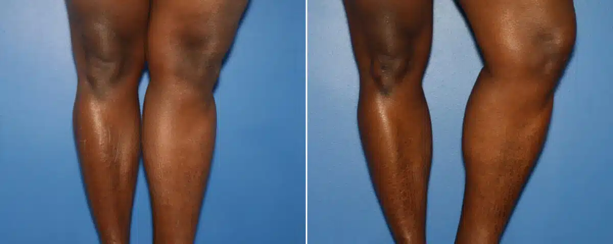 Calf Implants Before and After Photos in New York, NY, Patient 15871