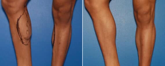 Calf Implants Before and After Photos in New York, NY, Patient 15855