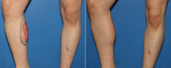 Calf Implants Before and After Photos in New York, NY, Patient 15879