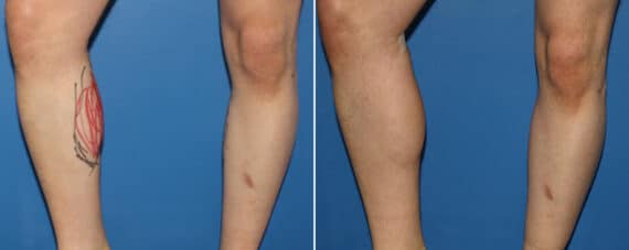 Calf Implants Before and After Photos in New York, NY, Patient 15879
