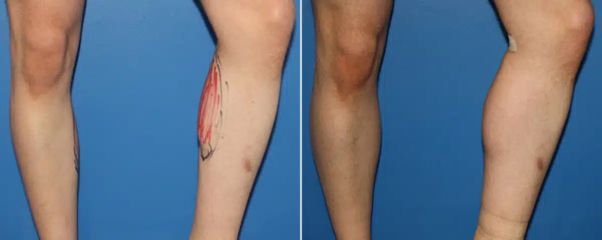 Calf Implants Before and After Photos in New York, NY, Patient 15879