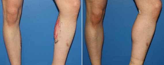 Calf Implants Before and After Photos in New York, NY, Patient 15879