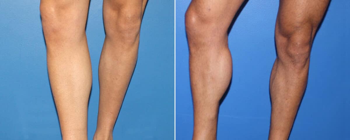 Calf Implants Before and After Photos in New York, NY, Patient 15887