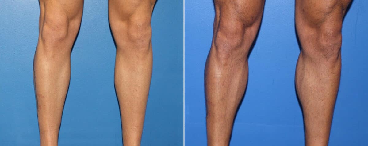 Calf Implants Before and After Photos in New York, NY, Patient 15887