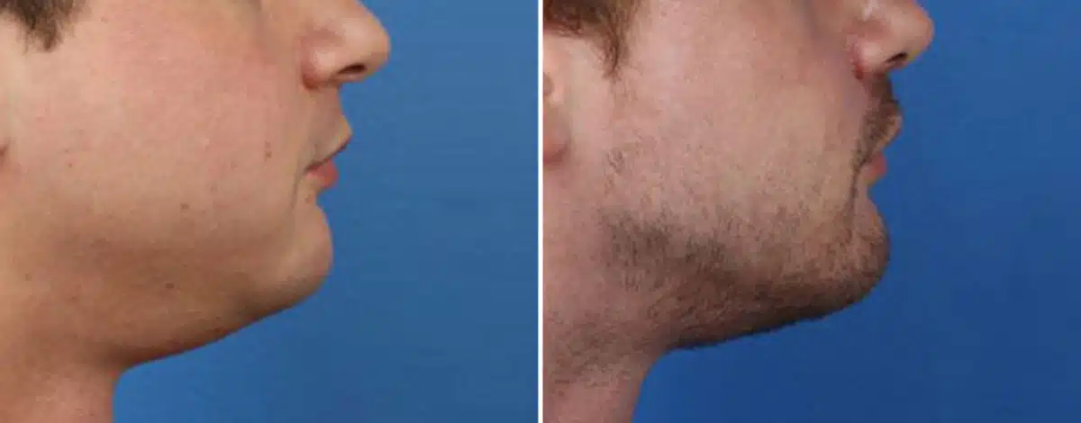 Chin Implant Before and After Photos in New York, NY, Patient 15712