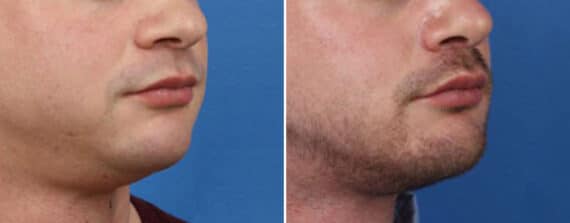 Chin Implant Before and After Photos in New York, NY, Patient 15712