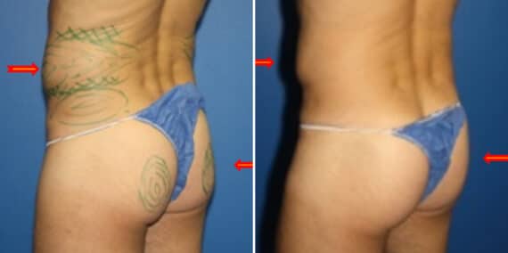 Fat Grafting Before and After Photos in New York, NY, Patient 15719