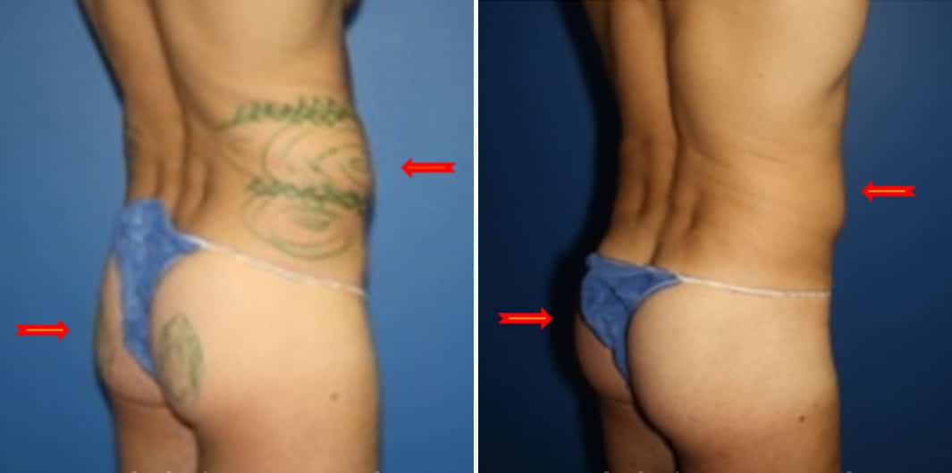 Fat Grafting Before and After Photos in New York, NY, Patient 15719