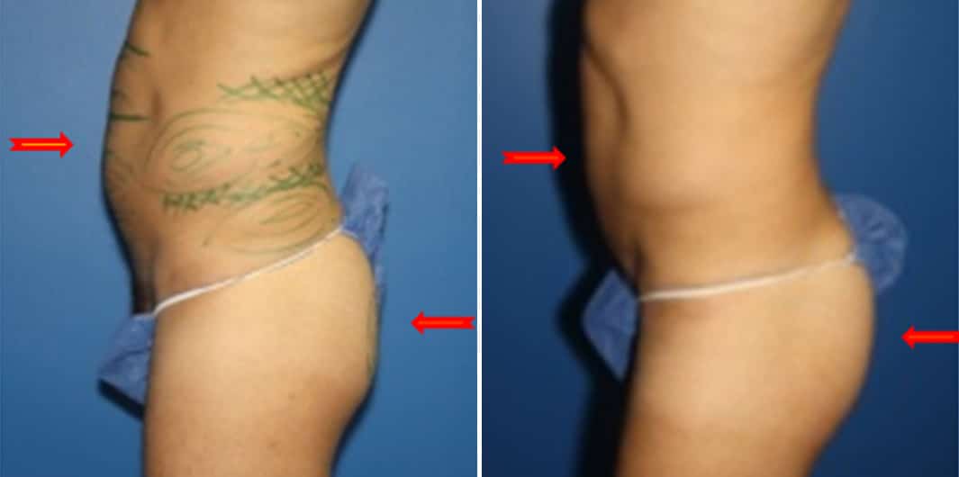 Fat Grafting Before and After Photos in New York, NY, Patient 15719