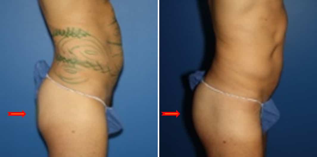 Fat Grafting Before and After Photos in New York, NY, Patient 15719