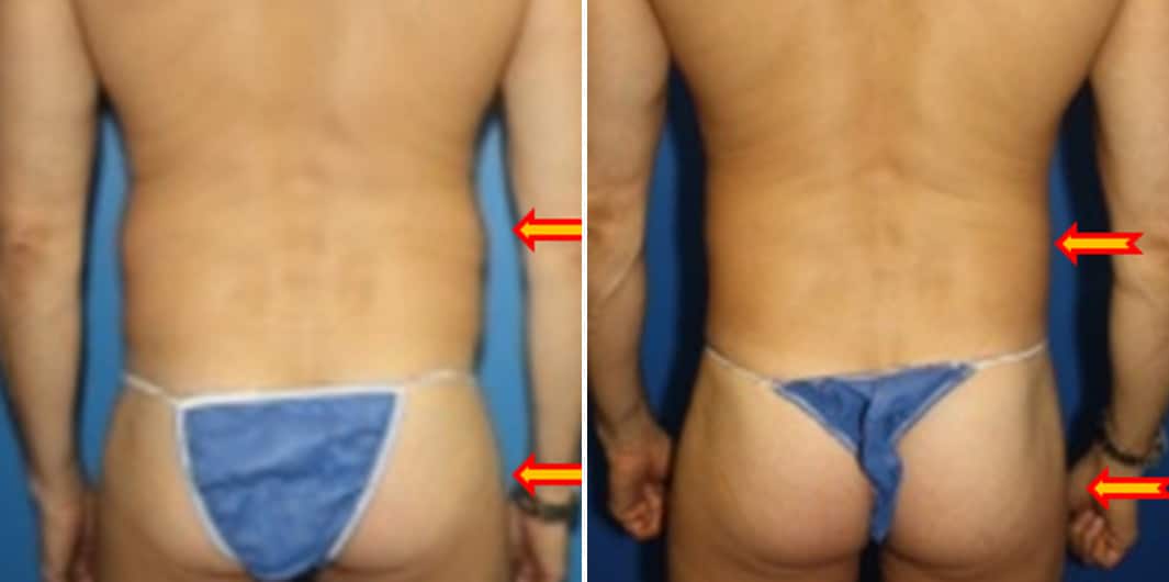 Fat Grafting Before and After Photos in New York, NY, Patient 15719