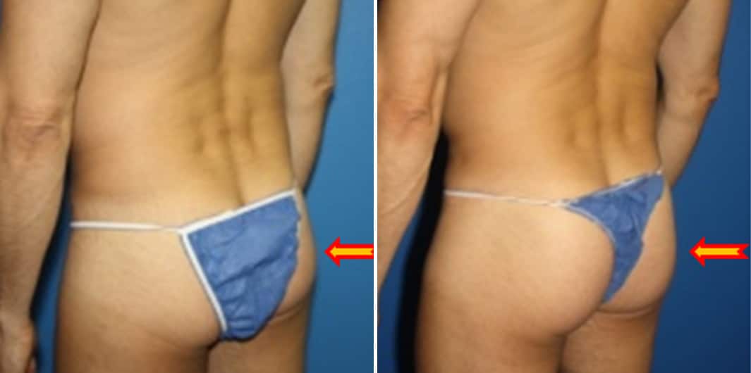 Fat Grafting Before and After Photos in New York, NY, Patient 15719