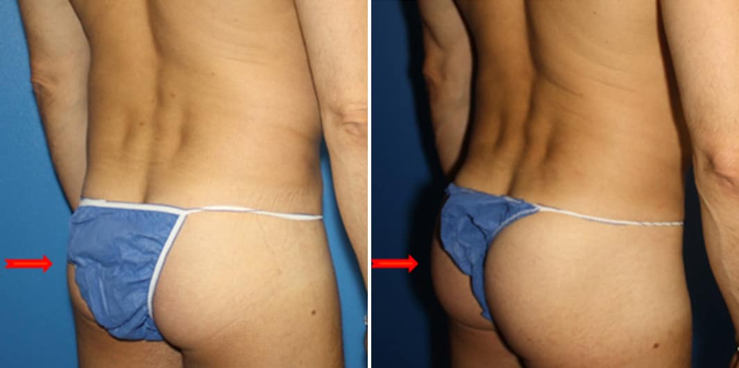 Fat Grafting Before and After Photos in New York, NY, Patient 15719