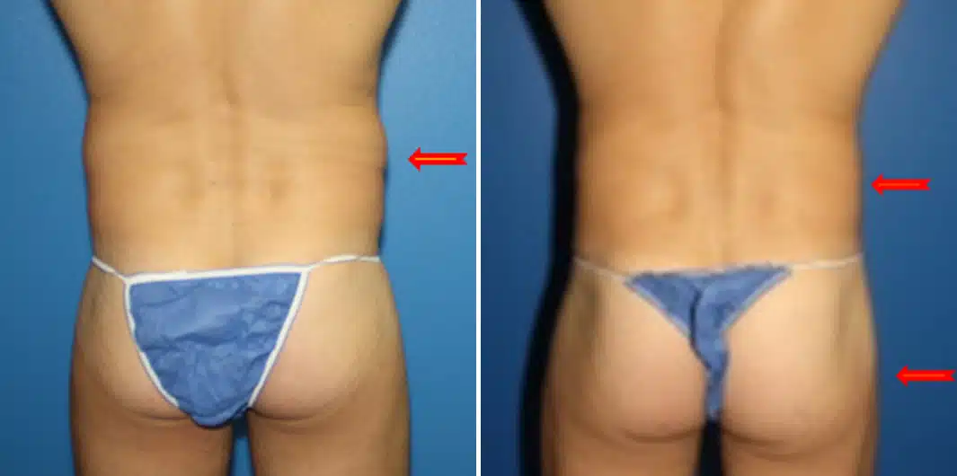 Fat Grafting Before and After Photos in New York, NY, Patient 15719