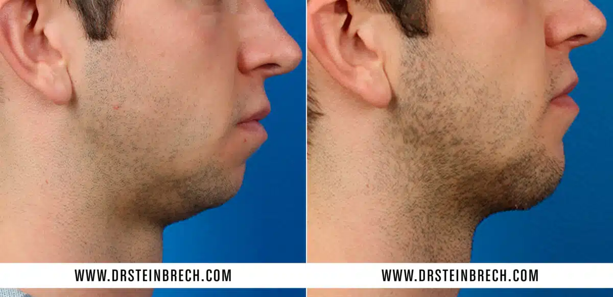 Chin Implant Before and After Photos in New York, NY, Patient 15585