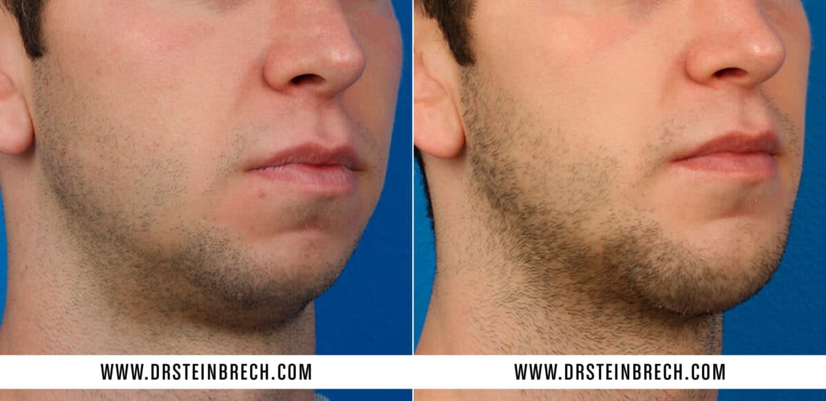 Chin Implant Before and After Photos in New York, NY, Patient 15585