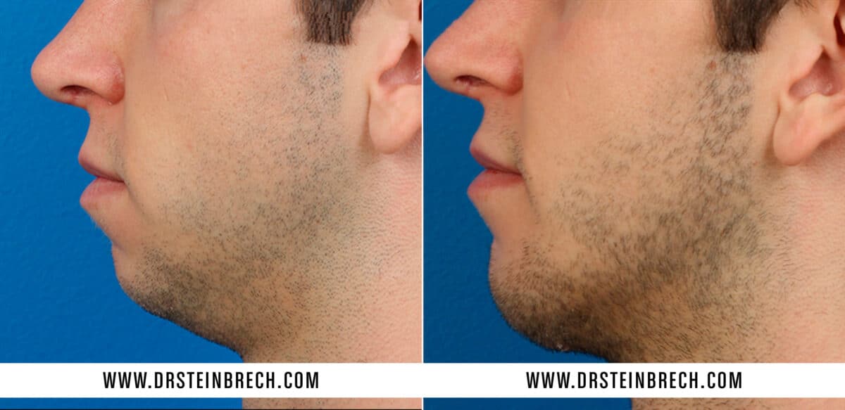 Chin Implant Before and After Photos in New York, NY, Patient 15585