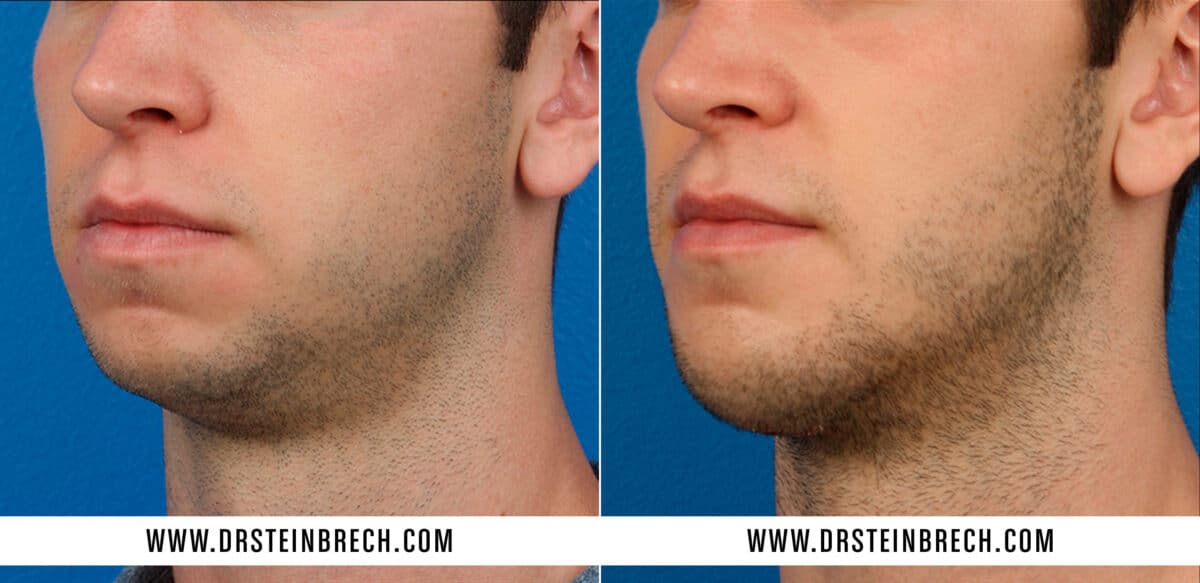 Chin Implant Before and After Photos in New York, NY, Patient 15585