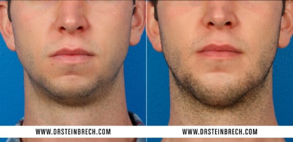 Chin Implant Before and After Photos in New York, NY, Patient 15585