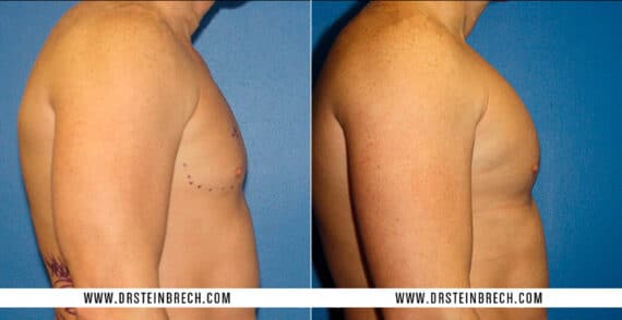 Pectoral Augmentation Before and After Photos in New York, NY, Patient 15485