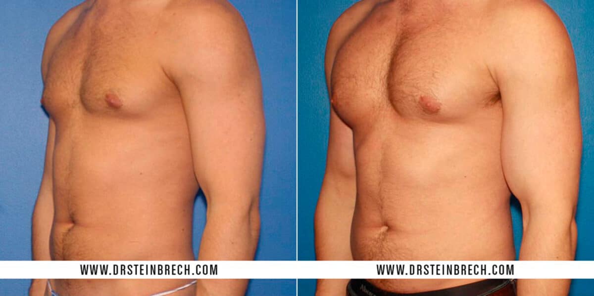 Pectoral Augmentation Before and After Photos in New York, NY, Patient 15516