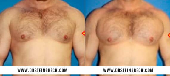 Pectoral Augmentation Before and After Photos in New York, NY, Patient 15527