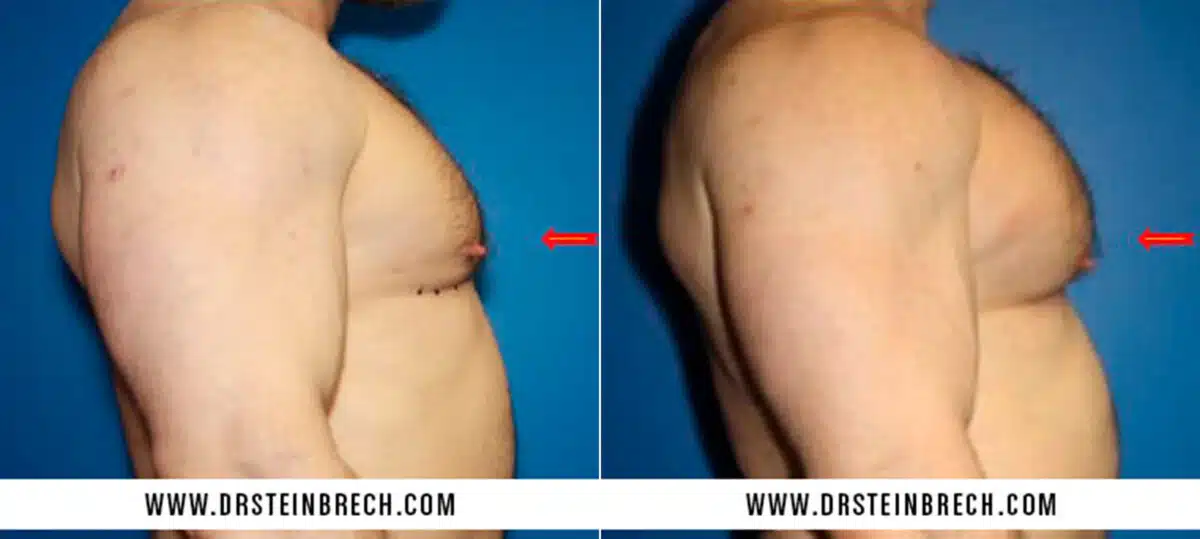 Pectoral Augmentation Before and After Photos in New York, NY, Patient 15527