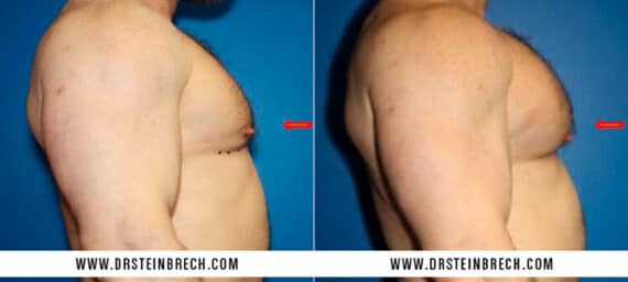 Pectoral Augmentation Before and After Photos in New York, NY, Patient 15527