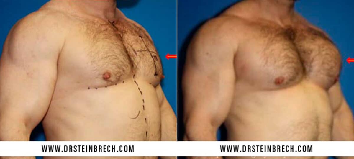 Pectoral Augmentation Before and After Photos in New York, NY, Patient 15527