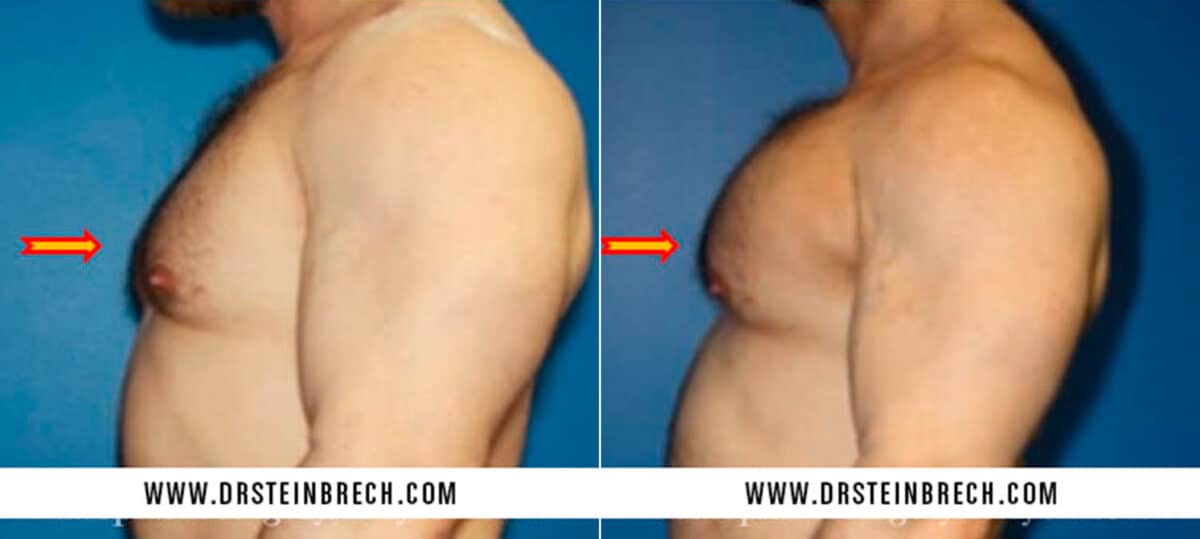 Pectoral Augmentation Before and After Photos in New York, NY, Patient 15527
