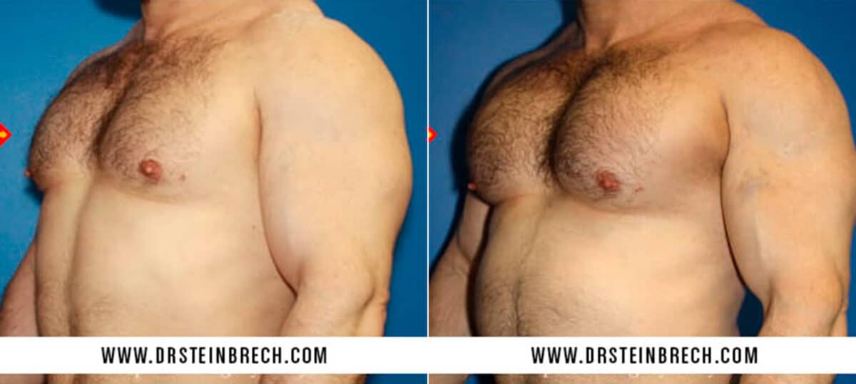Pectoral Augmentation Before and After Photos in New York, NY, Patient 15527