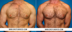 Pectoral Augmentation Before and After Photos in New York, NY, Patient 15546