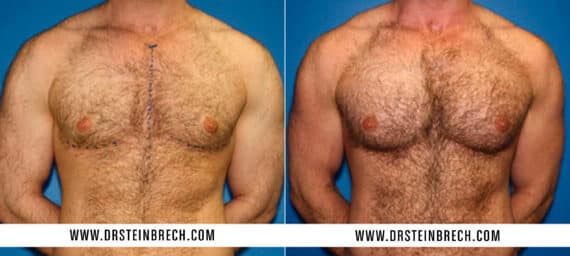 Pectoral Augmentation Before and After Photos in New York, NY, Patient 15546